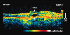 OCT (Optical coherence tomography)