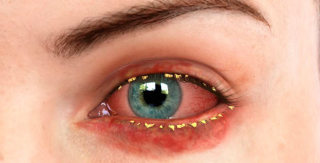 блефарит глаза лечение