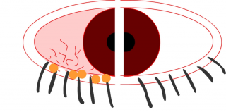 Симптомы и лечение блефарита глаз