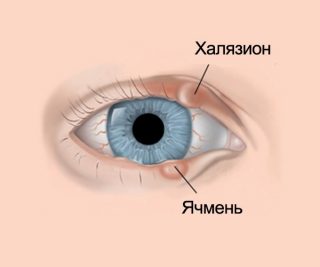 халязион на веке глаза