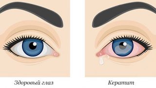 кератит глаза лечение