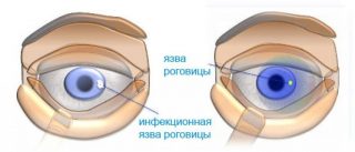 диагностика кератита глаза
