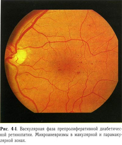 Васкулярная фаза препролиферативной диабетической ретинопатии
