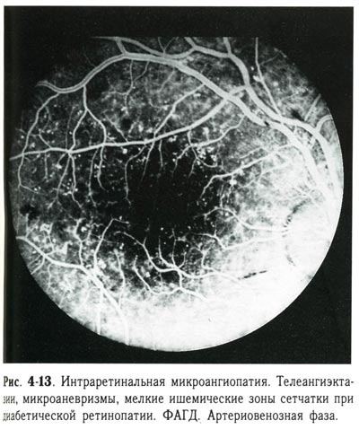 Телеангиэктазии, микроаневризмы