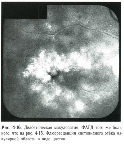 Диабетическая макулопатия