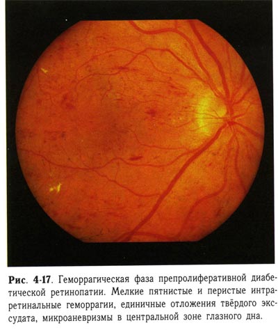 Геморрагическая фаза препролиферативной диабетической ретинопатии