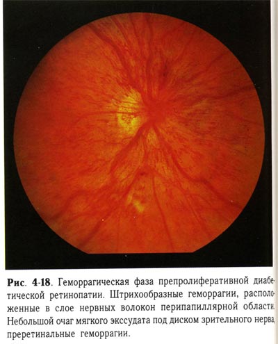 Геморрагическая фаза препролиферативной диабетической ретинопатии