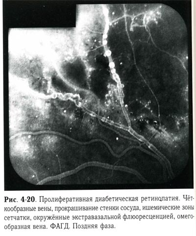 Пролиферативная диабетическая ретинопатия