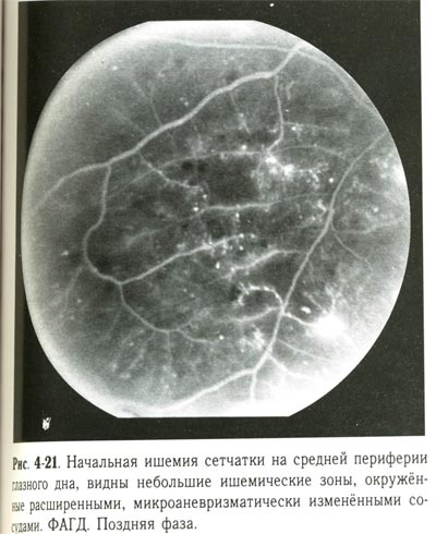 Начальная ишемия сетчатки