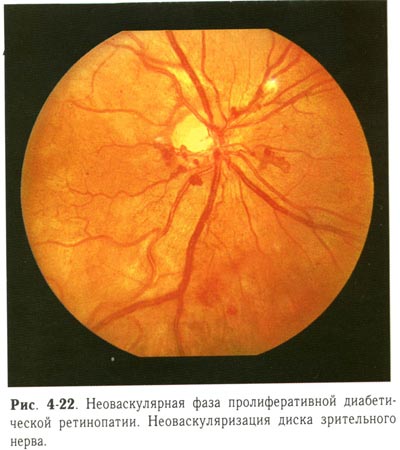Неоваскулярная фаза пролиферативной диабетической ретинопатии
