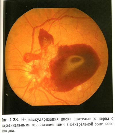 Неоваскуляризация диска зрительного нерва