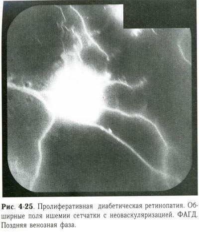 Пролиферативная диабетическая ретинопатия