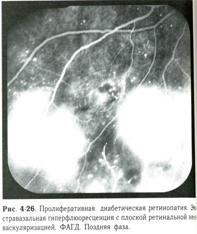 Пролиферативная диабетическая ретинопатия