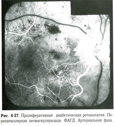 Пролиферативная диабетическая ретинопатия