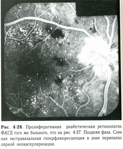 Пролиферативная диабетическая ретинопатия