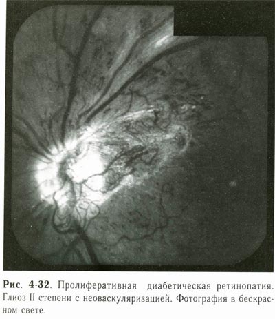 Начальный глиоз диска зрительного нерва
