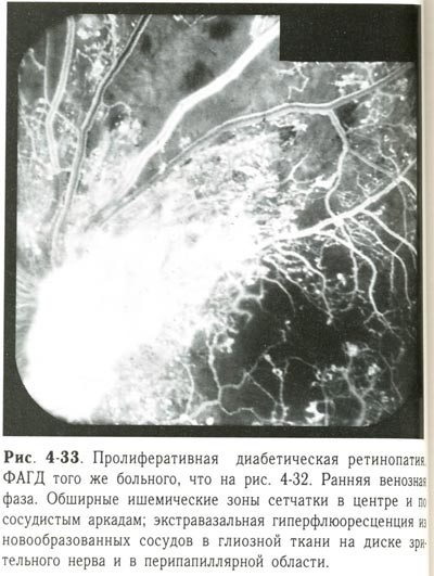 Пролиферативная диабетическая ретинопатия