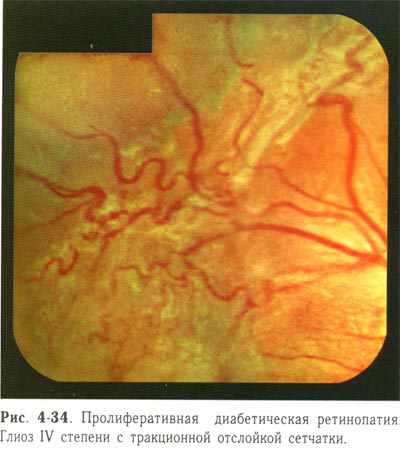 Пролиферативная диабетическая ретинопатия