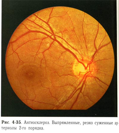 Ангиосклероз. Выпрямленные, резко суженные артериолы второго порядка