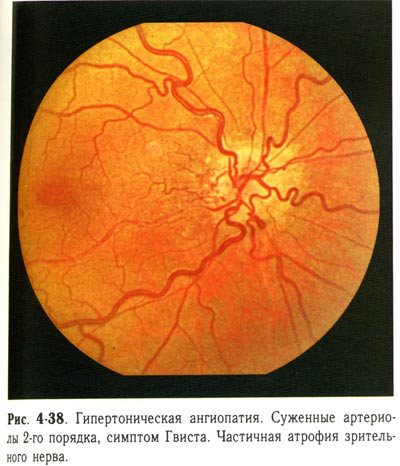 Гипертоническая ангиопатия