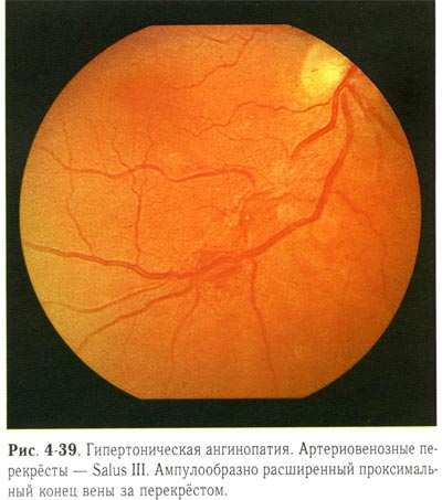 Гипертоническая ангиопатия обоих глаз