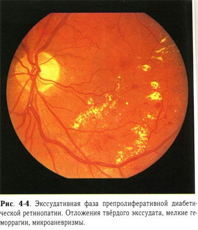 Экссудативная фаза препролиферативной диабетической ретинопатии