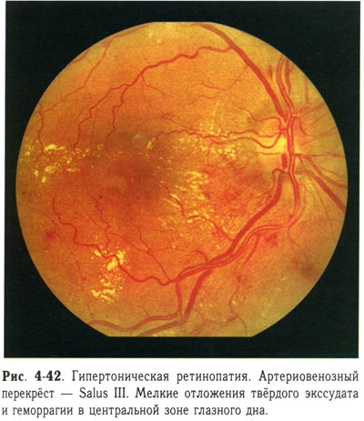Гипертоническая ретинопатия