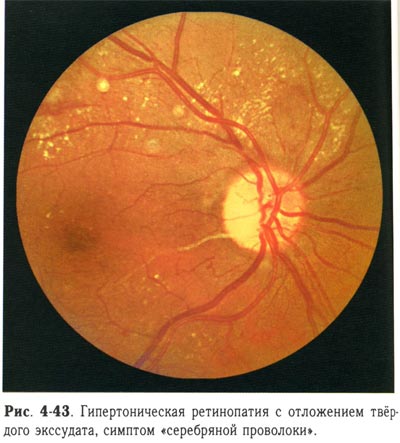 Гипертоническая ретинопатия