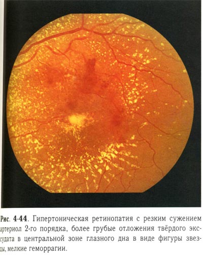 Гипертоническая ретинопатия