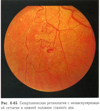 Гипертоническая ретинопатия