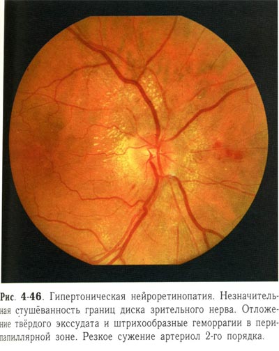Гипертоническая нейроретинопатия