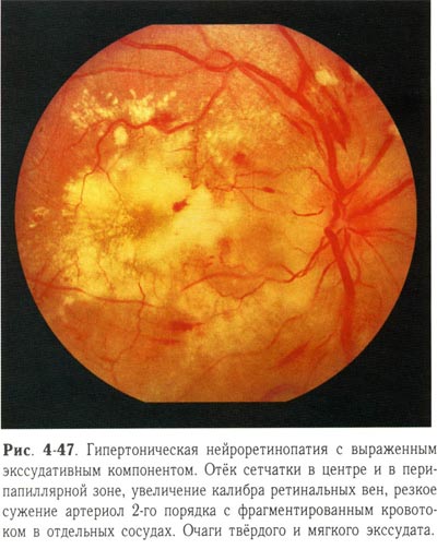 Гипертоническая нейроретинопатия