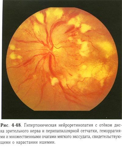 Гипертоническая нейроретинопатия