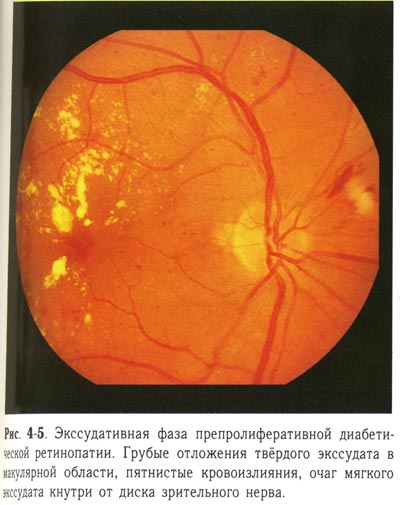 Экссудативная фаза препролиферативной диабетической ретинопатии