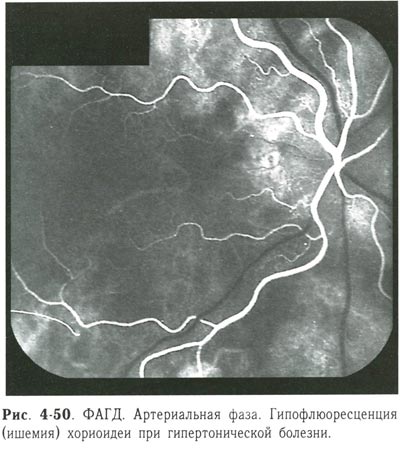 Гипофлюоресценция (ишемия) хориоидеи при гипертонической болезни