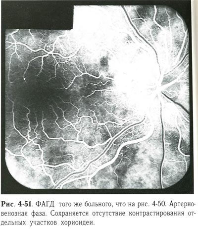 Сохраняется отсутствие контрастирования отдельных участков хориоидеи