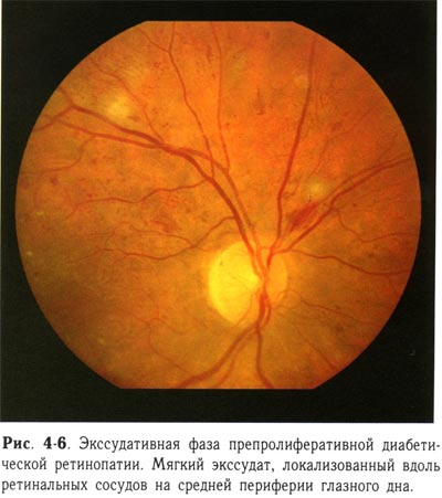 Экссудативная фаза препролиферативной диабетической ретинопатии