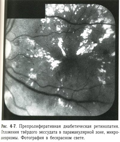 Препролиферативная диабетическая ретинопатия