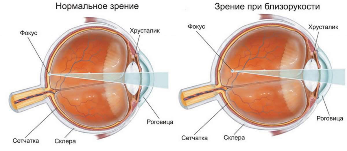 виды катаракты
