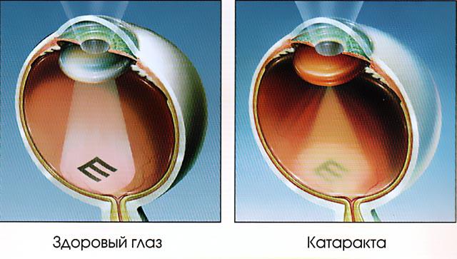 виды катаракты