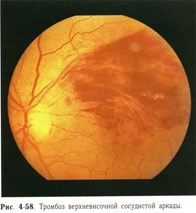 Картина глазного дна при тромбозе центральной вены сетчатки thumbnail