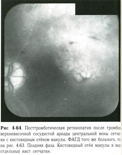 Посттромботическая ретинопатия 