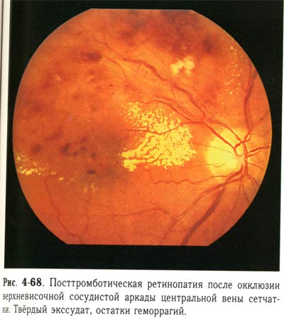 Посттромботическая ретинопатия