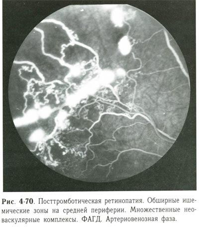 Посттромботическая ретинопатия