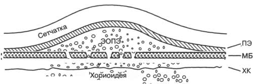 Сливные друзы сетчатки лечение