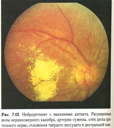 Нейроретинит с явлениями ангиита