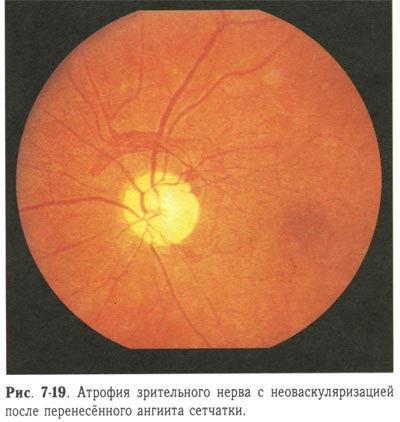 Атрофия зрительного нерва с неоваскуляризацией после перенесенного ангиита сетчатки