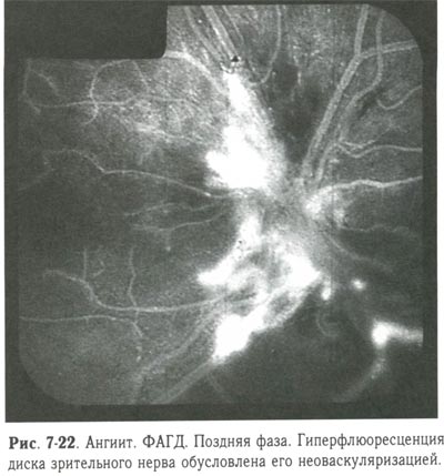 Гиперфлюоресценция диска зрительного нерва обусловлена его неоваскуляризацией