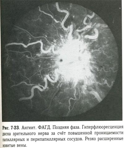 Гиперфлюоресценция диска зрительного нерва за счет повышенной проницаемости папиллярных и перипапиллярных сосудов