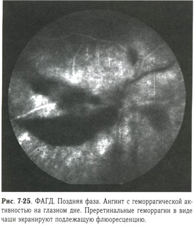 Ангиит с геморрагической активностью на глазном дне